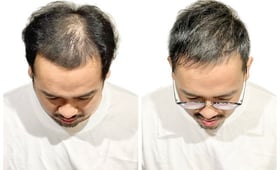 專家告訴你:如何選擇適合自己的植髮技術和醫院?